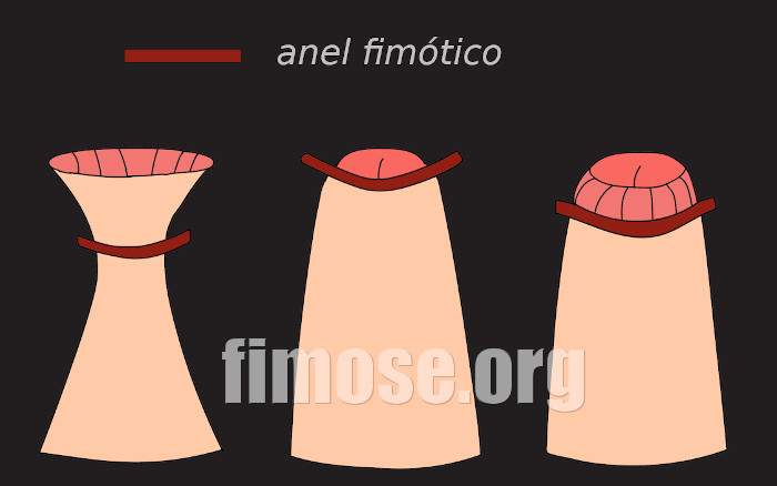 anel fimotico