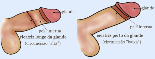 posição da cicatriz