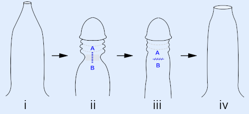diagrama prepucioplastia